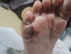 Kaki Melepuh Usai Melahirkan,  Pasien Gugat RS Sarah Medan