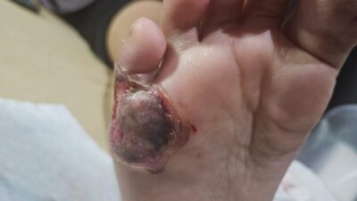 Kaki Melepuh Usai Melahirkan,  Pasien Gugat RS Sarah Medan